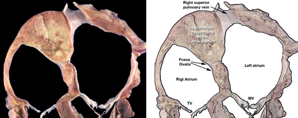 Lipomatous hypertrophy atrial septum mass